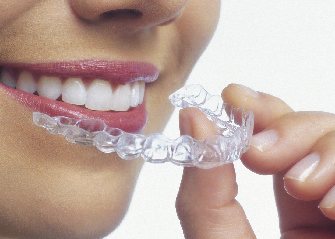 How Does Invisalign Work Spillers Orthodontics